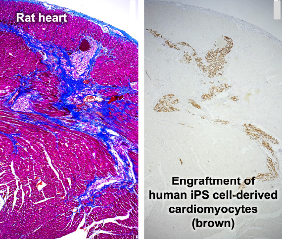 Regenerative therapy using iPS cells