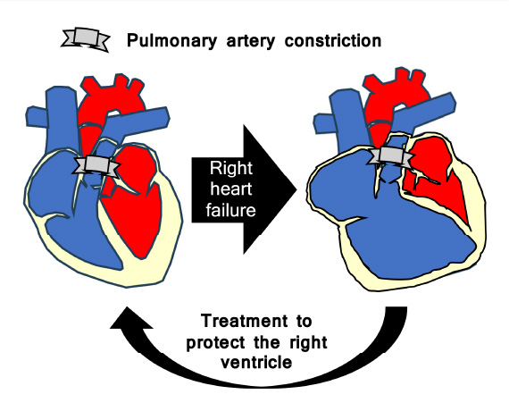 Pathological analysis and treatment of right heart failure