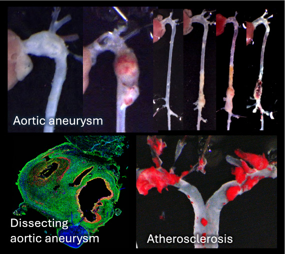 Exploring Novel Therapeutic Approaches for Atherosclerosis and Aortic Diseases