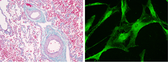 Characteristics of pulmonary artery smooth muscle cells from pulmonary hypertension and therapeutic innovation