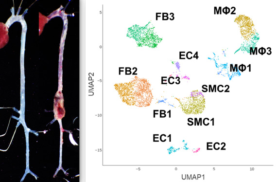 Uncovering the pathophysiology of cardiovascular diseases through ScRNA/SnRNAseq analysis