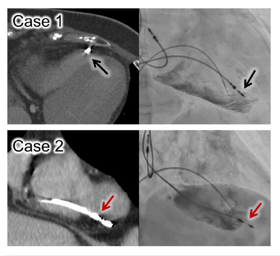 Imaging evaluation before lead extraction