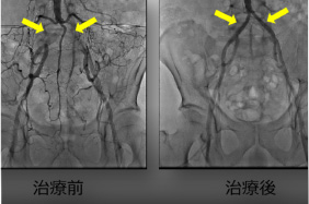 血管疾患