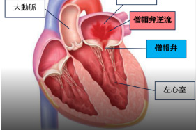 弁膜症